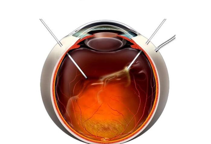 Surgical surgery - an activity to restore vision